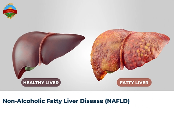 کبد چرب غیرالکلی (NAFLD) :